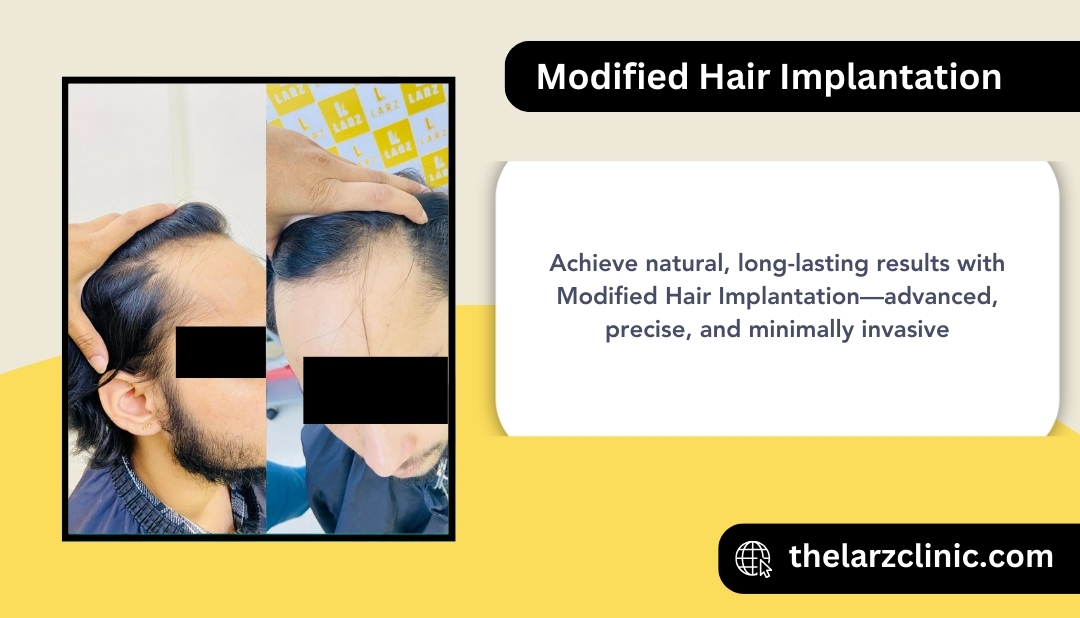 Modified Hair Implantation Technique in Mumbai